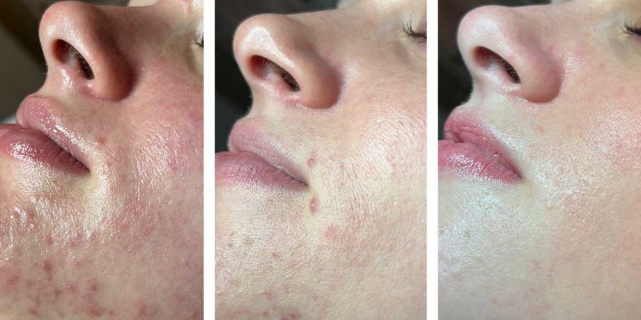  Sienna Skin and Beauty understanding acne